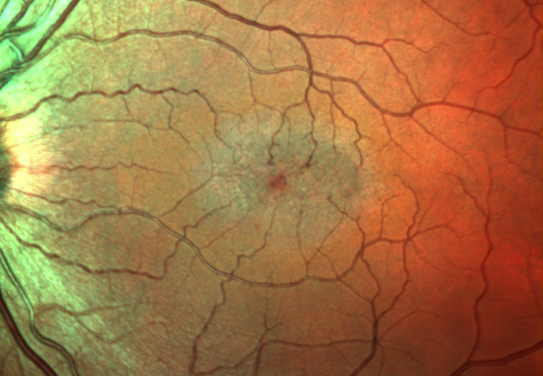 New Study Uncovers First Genetic Clues to Rare Eye Disease