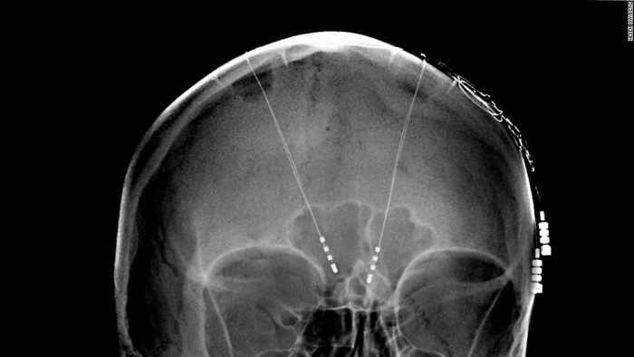 Brain Implant Successfully Boosts Memory For The First Time Ever